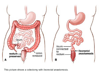 Colectomy with ileorectal anastomosis